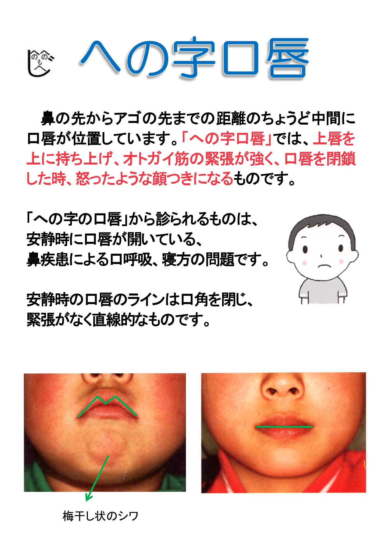 口 呼吸 顔つき